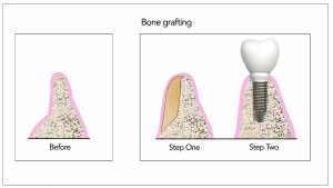 bone_graft
