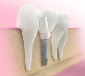 dental Implant