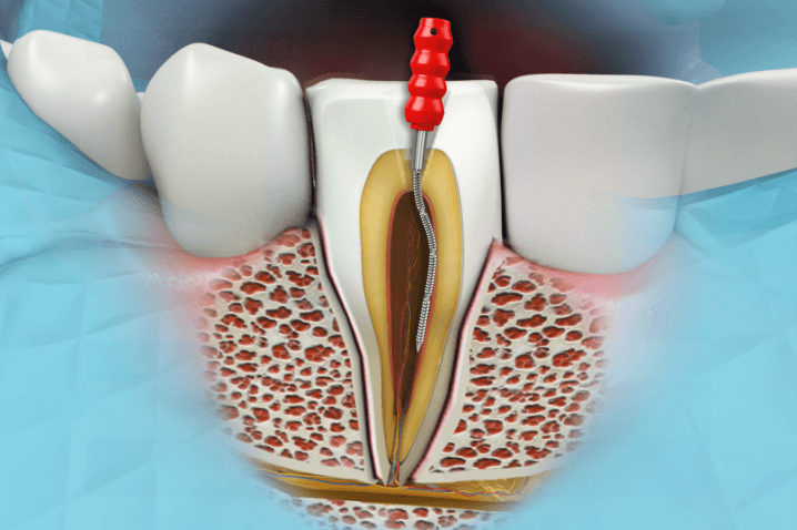 endodontics
