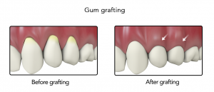 gum_grafting