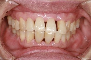 gum_recession