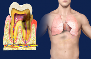 periodontal_disease_and_respiratory_disease