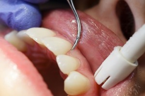 periodontal_disease_n
