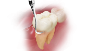 periodontal_scaling_and_root_planning