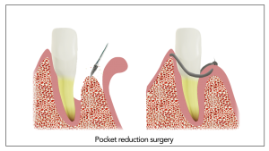 pocket_reduction