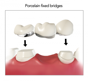 porcelain_fixed_bridges