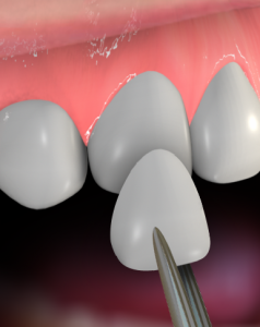 porcelain_veneers