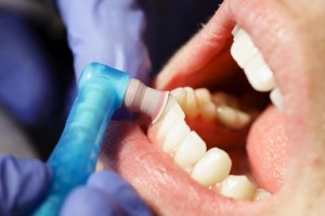 prophylaxis_cleaning