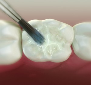 sealants