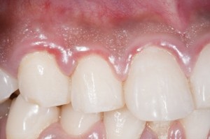 signs_and__symptoms _periodontal_disease
