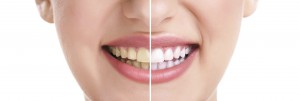 tooth_whitening